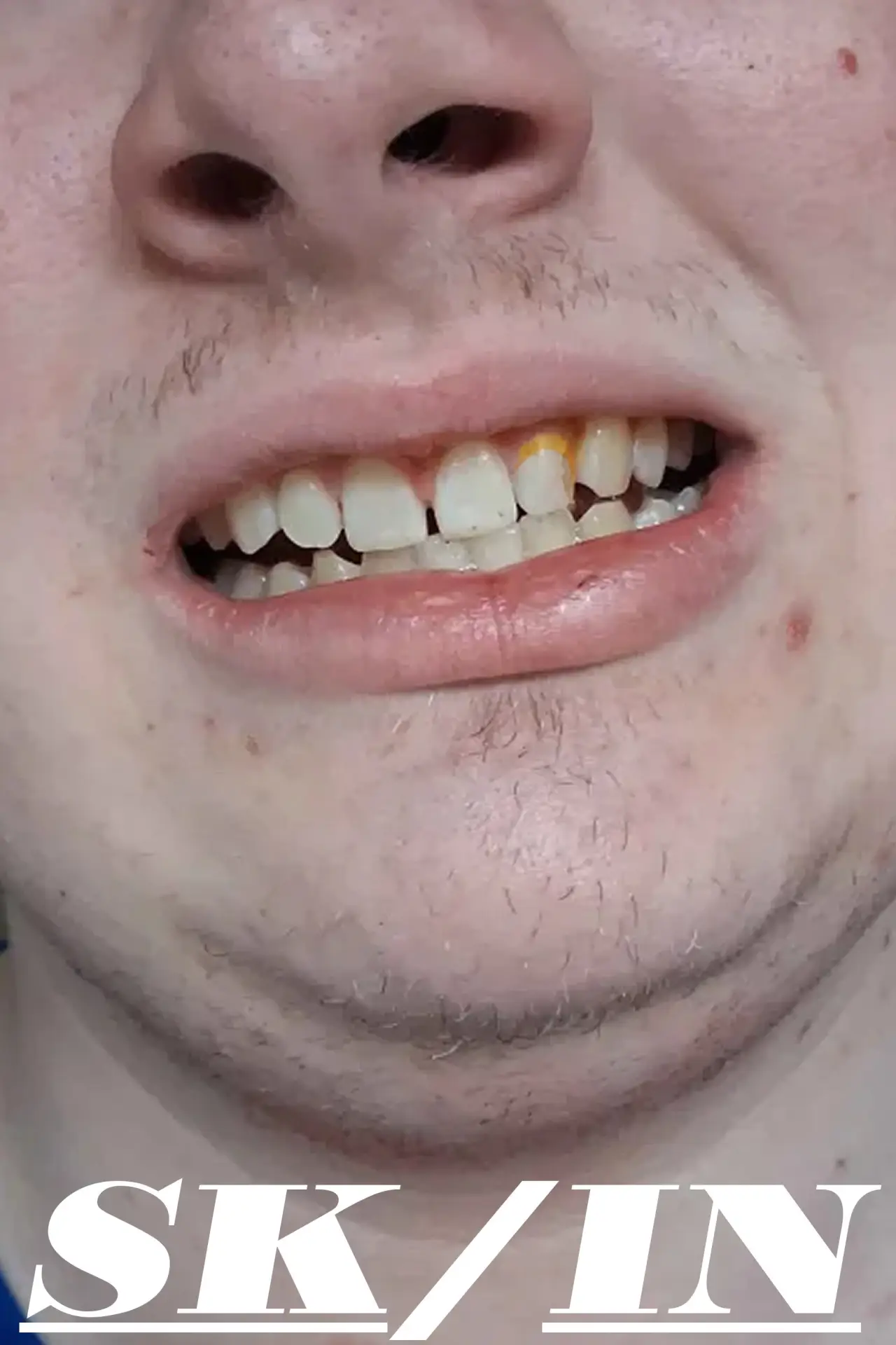 Постер к фильму "Skin"